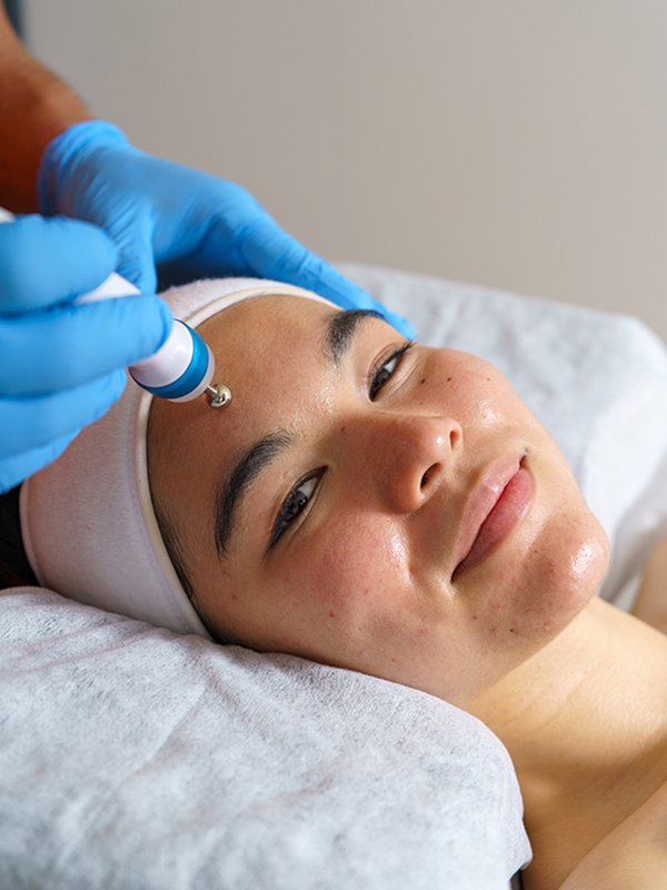 service microneedling
